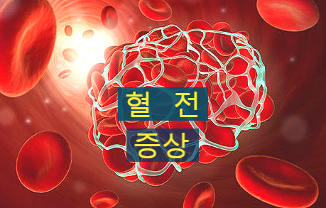  아스트라 제네카 혈전증상 부작용 미리 알고 예방하세요