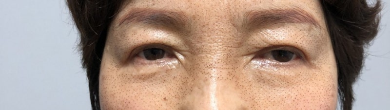 플라즈마 블라스트 콧날 옆주름 1-2일차(안쪽둘레) 6