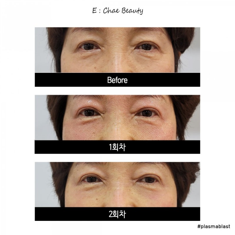 플라즈마 블라스트 콧날 옆주름 1-2일차(안쪽둘레) 1