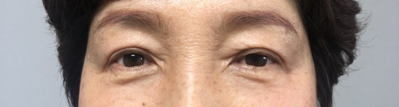 플라즈마 블라스트 콧날 옆주름 1-2일차(안쪽둘레) 4