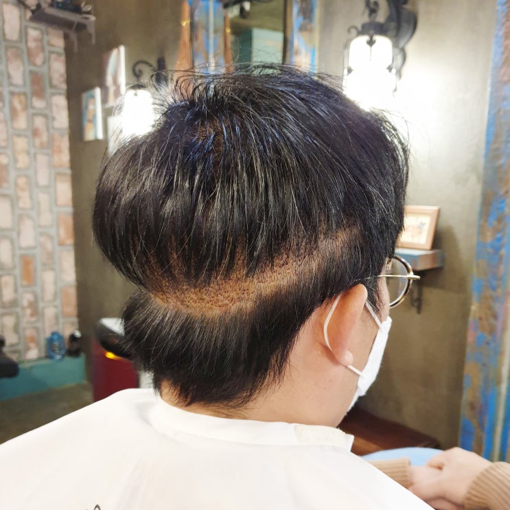  모발이식 후 부분가발 알아보고 있다면?