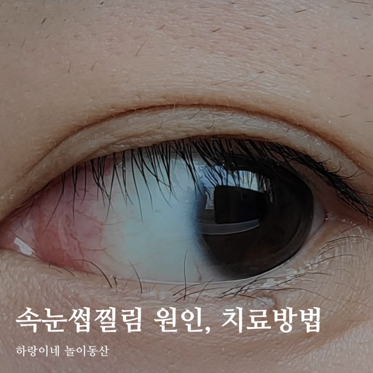  광주안과 속눈썹찔림 첩모난생증 원인과 치료방법