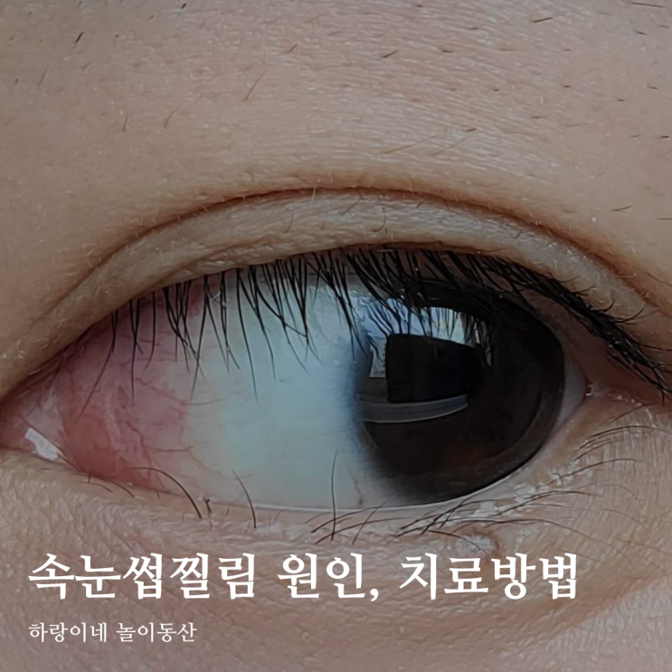 광주안과 속눈썹찔림 첩모난생증 원인과 치료방법