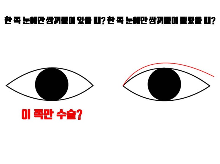  한쪽만 쌍수 난 반댈세!!! 한 쪽만 풀렸어도 쌍수는 양쪽 눈꺼풀에 모두!!!