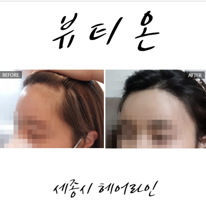  세종시 나성동 뷰티온 헤어라인 반영구 후기