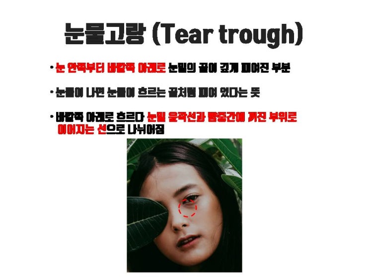  모두 다 눈밑지방 재배치할 필요 없어요!!! 눈밑지방 제거만으로도 효과 좋은 눈꺼풀도 있죠.