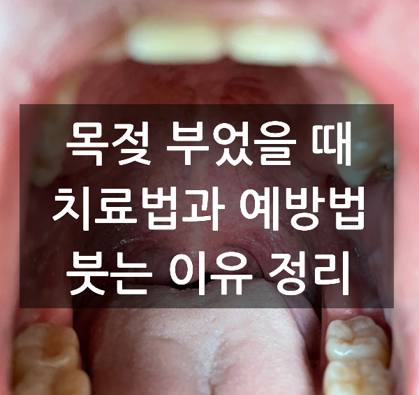 목젖 부었을 때 치료법과 예방법, 붓는 이유