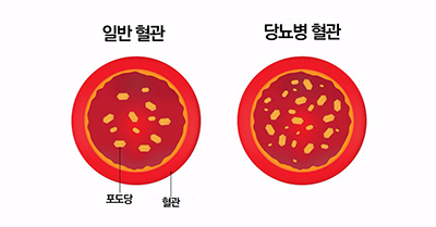 당뇨병 원인과 예방｜무서운 합병증