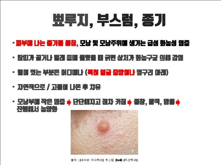  코수술 후 코 주위의 작은 뾰루지 함부로 짜면 코수술 감염은 물론   뇌의 감염 발생할 수 있어요!!!