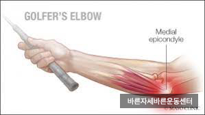 골프엘보우 (Golf elbow)