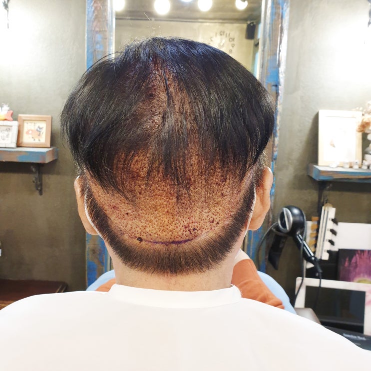  M자 탈모 초기 모발이식 해야하나?