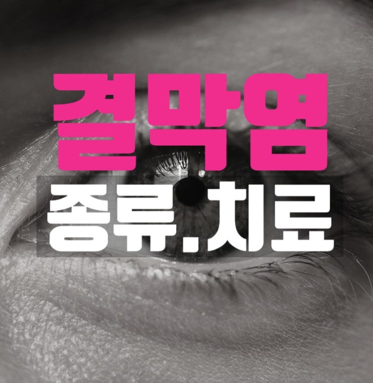  꽃가루 봄철 바이러스 알레르기 결막염 증상 원인 치료 안약 유행성 전염