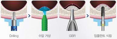  뼈가 부족할때 임플란트 상악동 골이식술 (수압거상) 방법 (응암역 치과)
