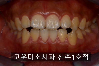  돌출&비대칭 치아교정 사례         [교정] 연세고운미소치과 신촌1호점