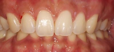 치아 사이 벌어질때 치료 방법 (응암역 치과)