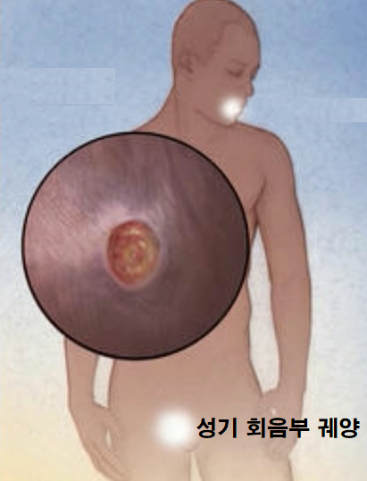헤모필루스 듀크레이 궤양