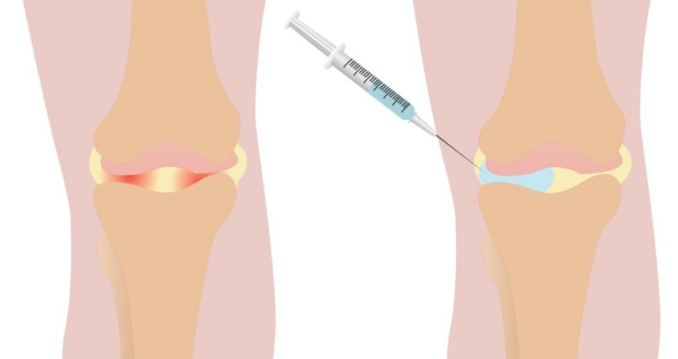  부산 지긋지긋한 퇴행성관절염 건강보험 적용 콘쥬란주사