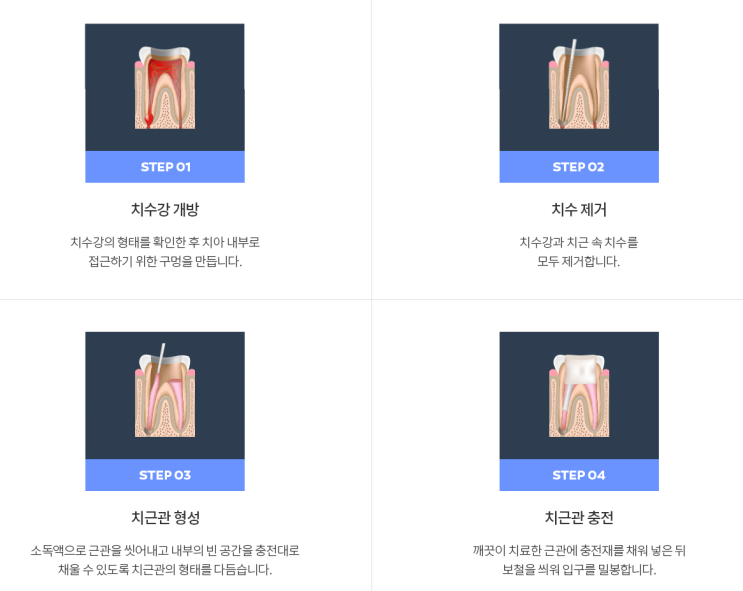  신경치료 후 주의사항 다섯가지