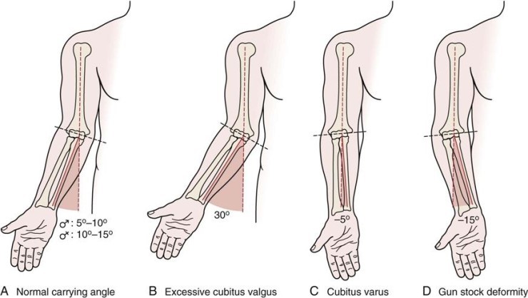  [이수역필라테스] 팔꿉관절 외반주 (cubitus valgus) & 내반주 (cubitus varus) 관련 편