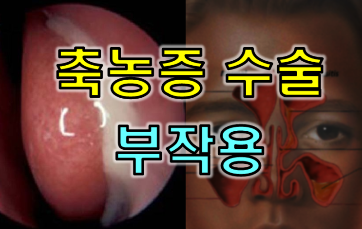  축농증 수술을 받은 38세 회사원 - 수술후 발생할수 있는 부작용은 어떤게 있나요?