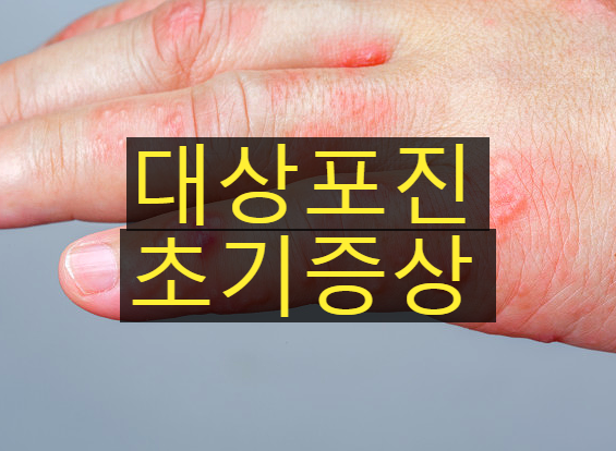  대상포진 초기증상, 예방접종 가격 원인 확인해 보세요