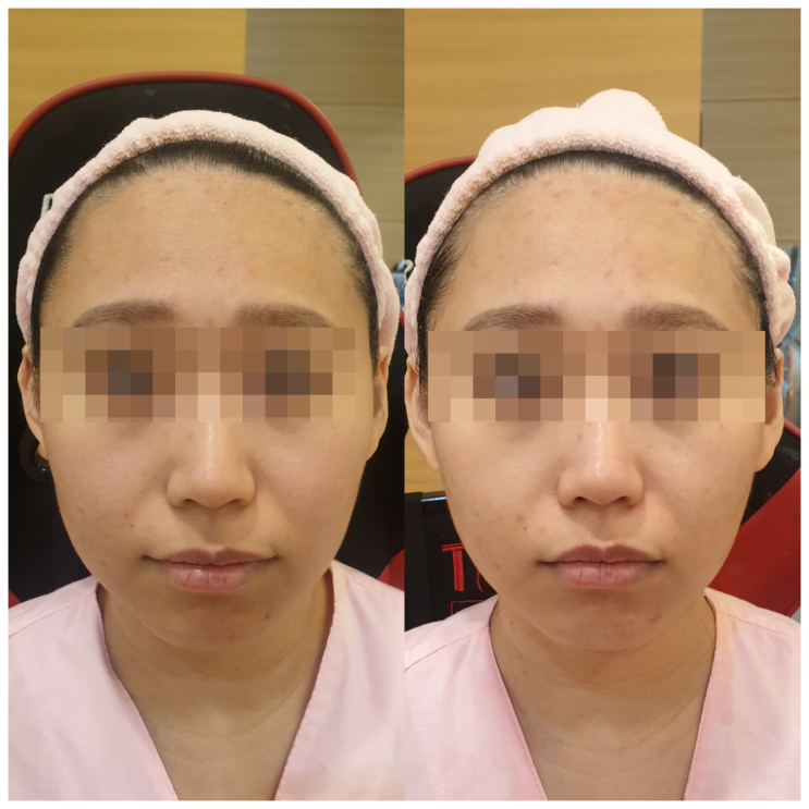  피부미백 피부관리는 나르시피아 얼굴이 작아지고 여드름이 깨끗!