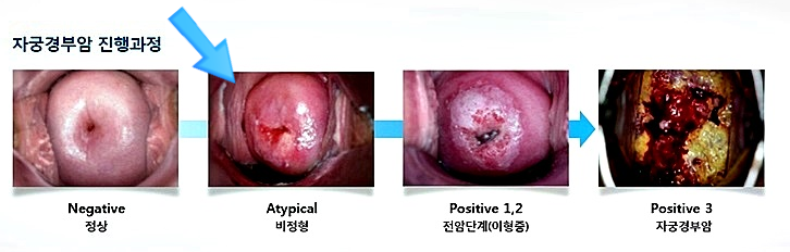 자궁 경부 비정형 세포의 관리 관찰