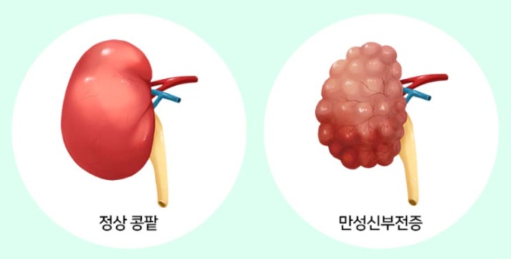  필수 지식 - 만성신부전, 만성콩팥병증 이란?
