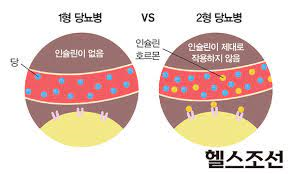 당뇨병1형2형 원인증상 진단검사치료 합병증 당뇨인슐린총정리 간호중재케이스