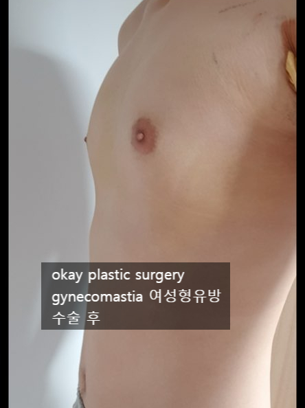  여유증 여성형 유방