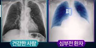 울혈성심부전CHD 원인증상 진단검사약물치료 합병증예후 심부전총정리 간호진단케이스