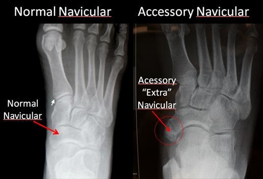 Accessory navicular syndrome/ 부주상골 증후군/ 발레 전공생 발 통증/ 발 내측 통증/ 발바닥 통증