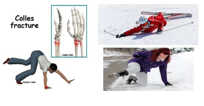원위 요골 골절 수술 후 단계, 주차별 재활운동 - Distal radius fracture surgery ...