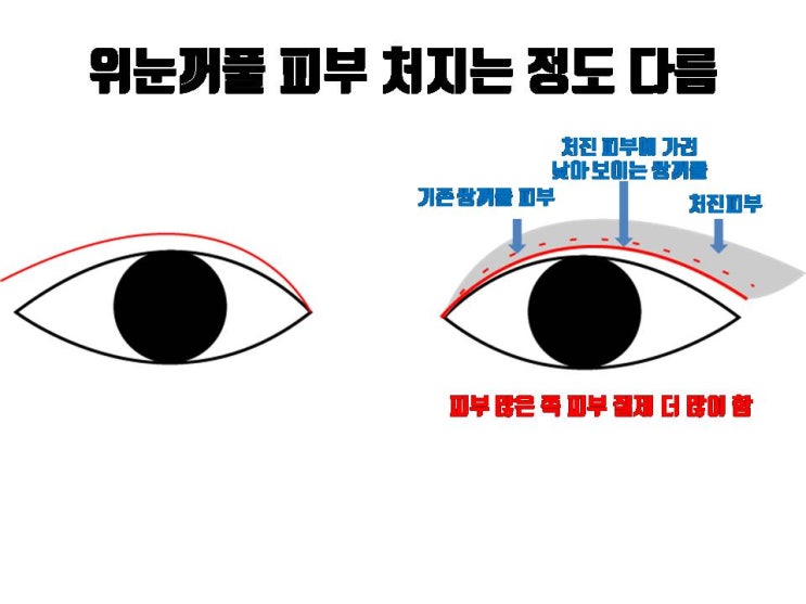  쌍수 짝짝이만 교정한다고 쌍수 후 짝눈이 사라지는 것은 결코 아니죠!!!