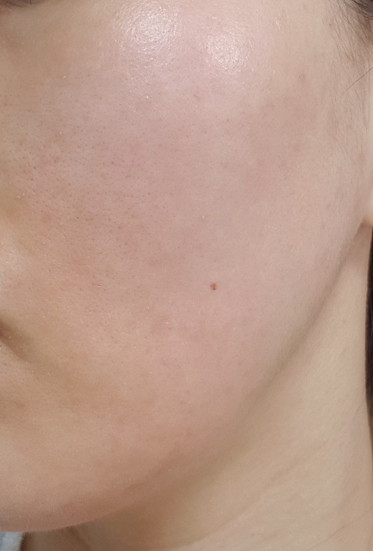  <피부일기> 수란트라 11일차/ 모낭염/ 주사피부염/ 안면홍조/ 지루성피부염/ 날치알염증