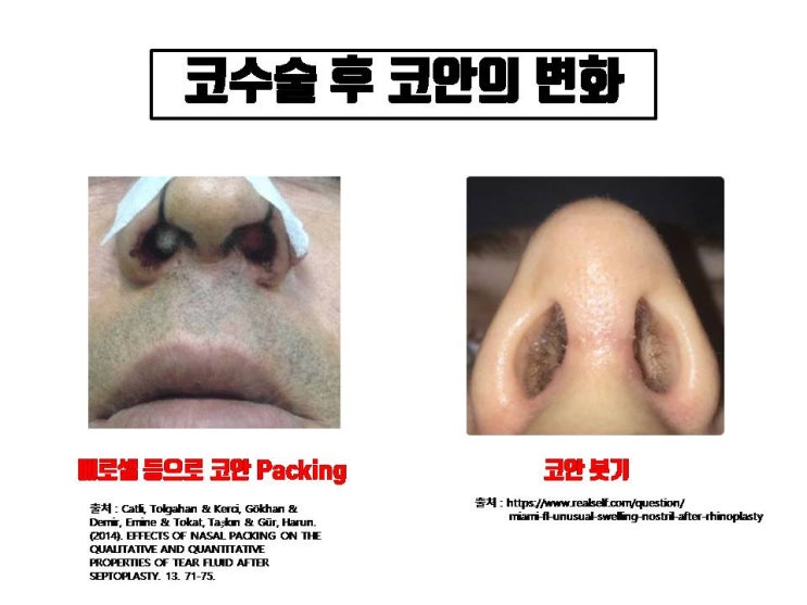  코수술 후 두통 코수술솜, 코성형 붓기로 인한 코막힘과 관련 있어요!!!