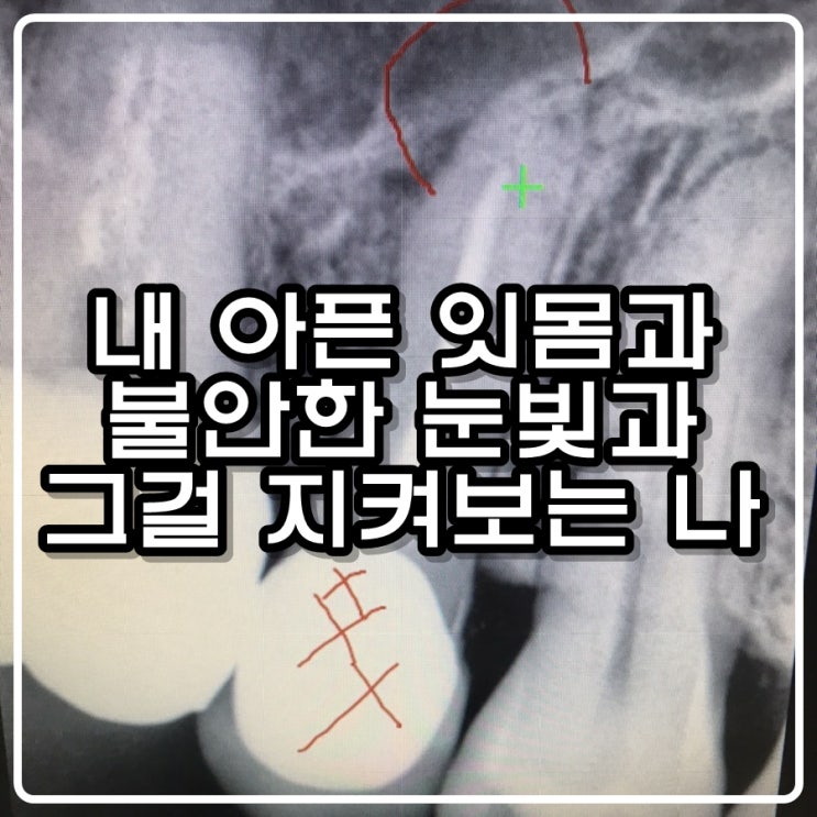 내 아픈 잇몸과 불안한 눈빛과 그걸 지켜보는 나 내 아픈 잇몸과 불안한 눈빛과 그걸 지켜보는 나