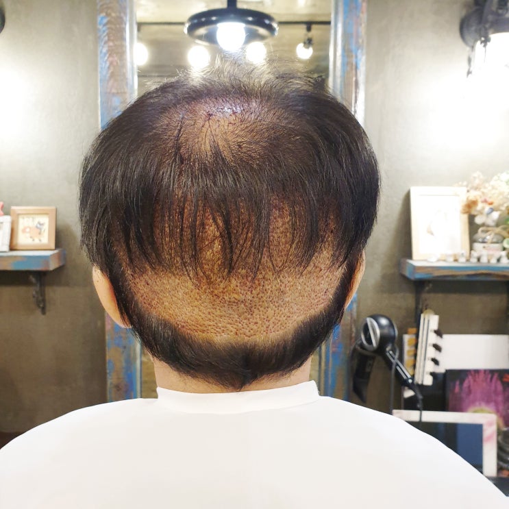  흉터모발이식 해도 될까?