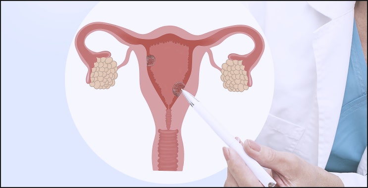  자궁선근증치료방법?적출 권유받으신 분들은 보세요.