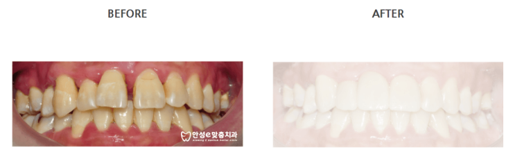  앞니 충치 치료방법에 대해 알아봐요