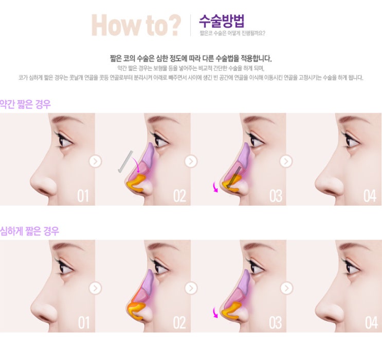  광주남자코성형, 인터넷 후기만 믿고 결정해도 될까?