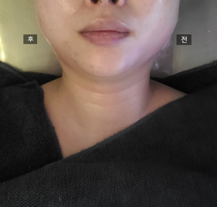  춘천 피부관리 제이스킨앤바디 전/후 차이 확실한 곳