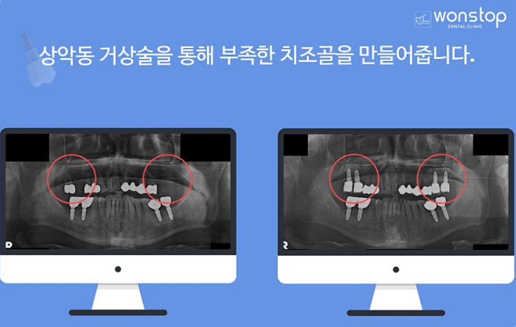  임플란트뼈이식비용? 가격보다 먼저 살필 1가지