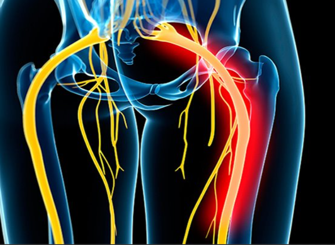  [서래마을 PT] 좌골 신경통 Sciatica 이란?
