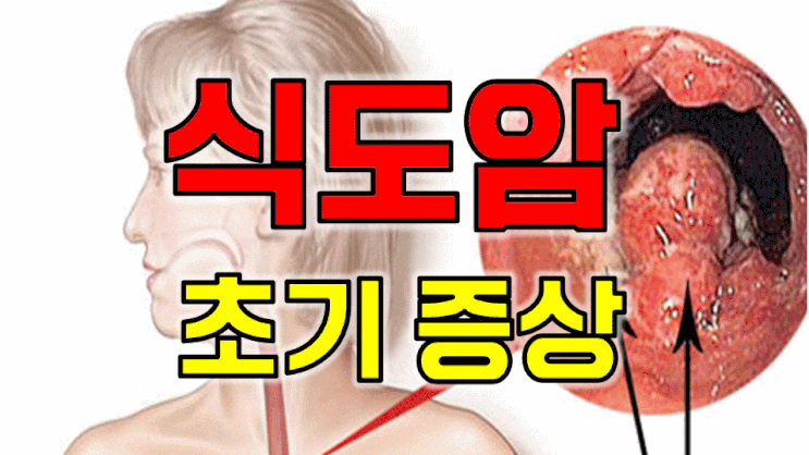  "혹시 식도암 인가요?" 반드시 알아야할 식도암 초기증상 6가지