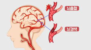 간호학 뇌졸중CVA 원인증상 치료약물합병증 뇌출혈간호진단케이스 문헌고찰