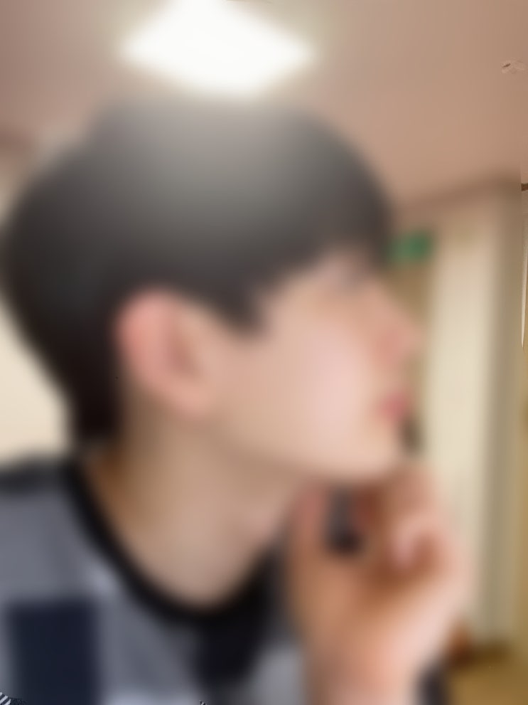  부산 남자 코성형,코수술 리얼 후기! 4개월차.. 진짜 붓기 빠질까??