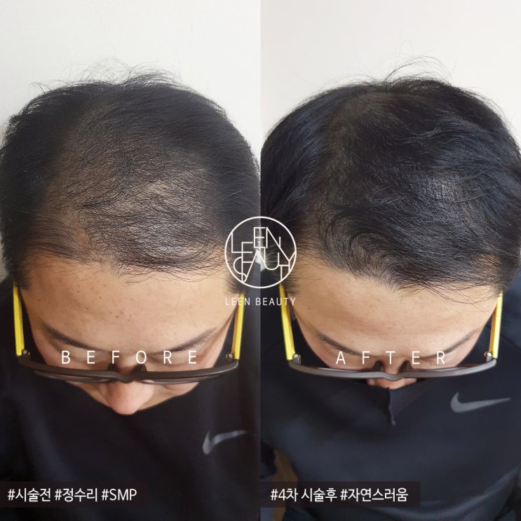  강남두피반영구 섬세한 터치로 자연스럽게!