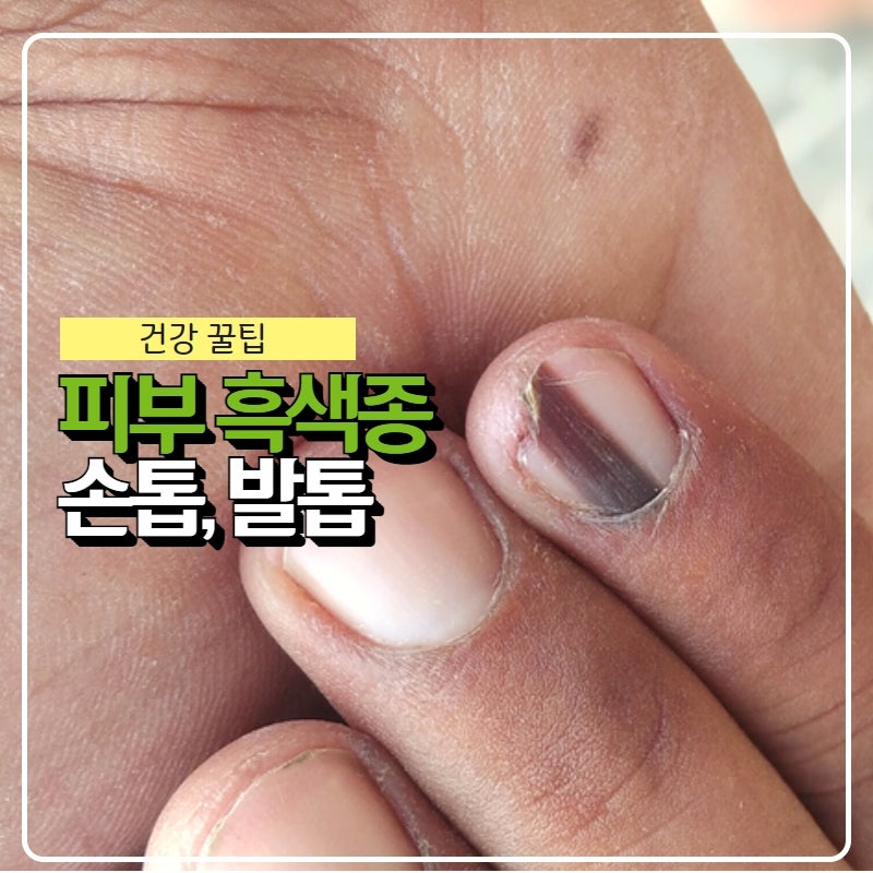 피부흑색종 증상, 손톱 발톱 발바닥