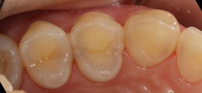 치아 옆면 충치 치료 방법 (응암역 치과)